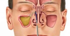 طرق علاج الجيوب الأنفية
