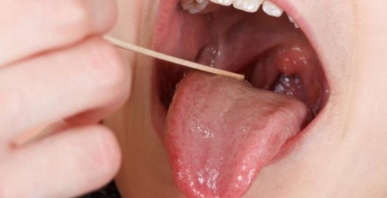 علاج احتقان الحلق