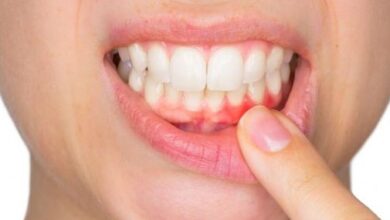 علاج التهاب اللثة
