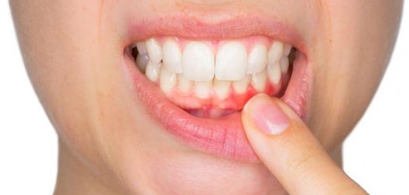 علاج التهاب اللثة