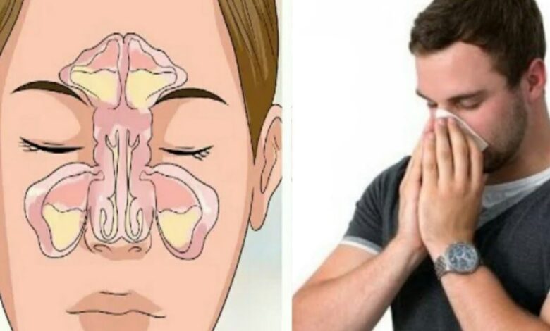 علاج الجيوب الأنفية نهائيا