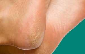 علاج تشققات الكعبين