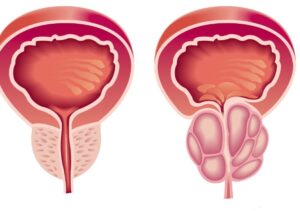 علاج تضخم البروستاتا